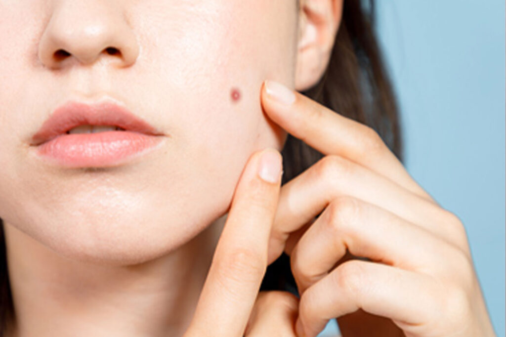 お悩みの多いお顔のいぼ·ホクロ
気になる顔の悩み。いぼ・ホクロの種類と治療