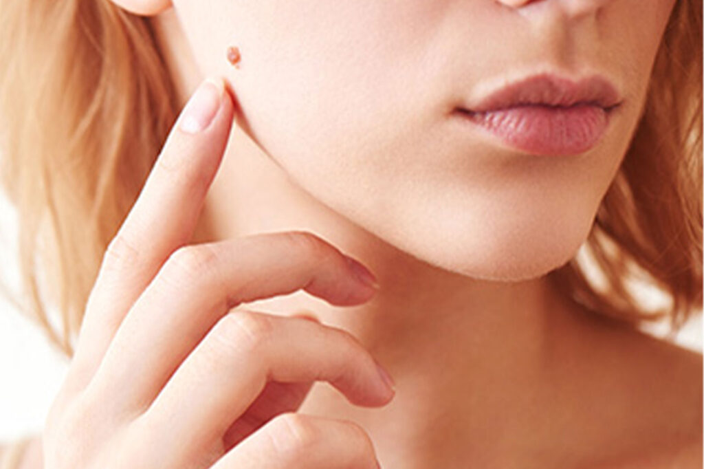 そのホクロ、安全ですか?
危険な兆候は?皮膚がんとの見分け方