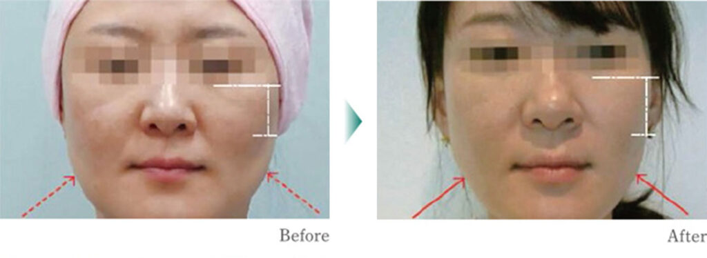 切らないフェイスリフトをご存じですか?
HI-FU(ハイフ)でたるみを改善!最新治療ダブロ