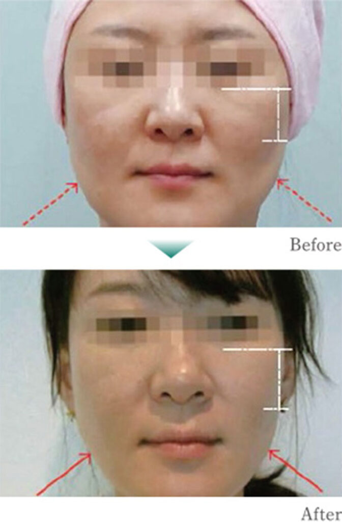 切らないフェイスリフトをご存じですか?
HI-FU(ハイフ)でたるみを改善!最新治療ダブロ